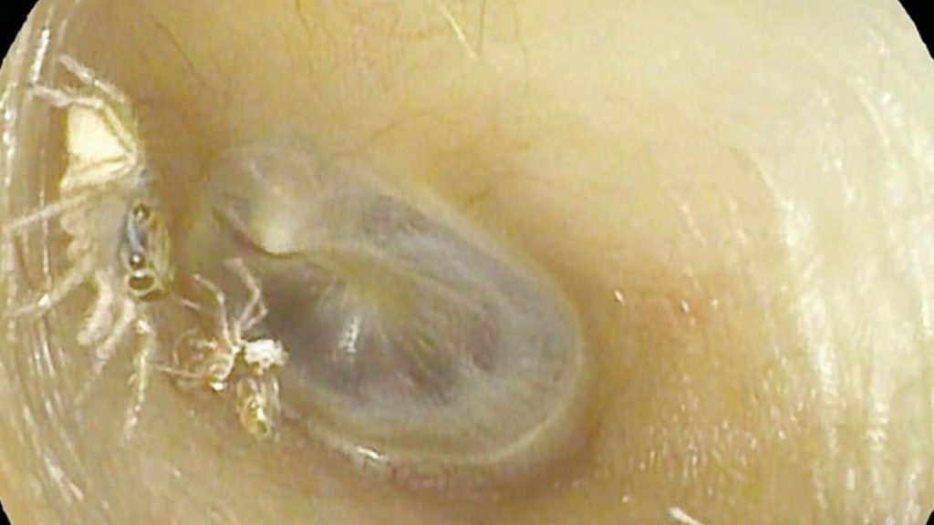 Майже фантастика: перуанський павук-вовк вкусив британця і відклав яйця в рану Майже фантастика: перуанський павук-вовк вкусив британця і відклав яйця в рану