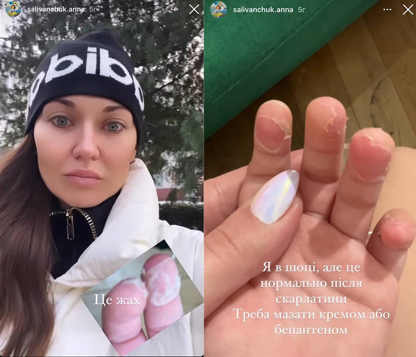 Це жах: Саліванчук показала, як у сина облазить шкіра на руках після скарлатини Це жах: Саліванчук показала, як у сина облазить шкіра на руках після скарлатини