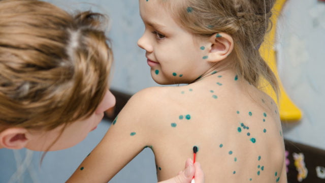 Особиста гігієна при вітрянці: лікарка розповіла, чи можна митися