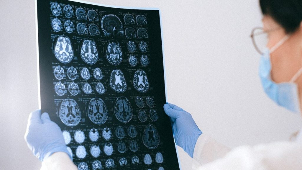 Прорив у неврології: мозкові імпланти допомагають відновитися після черепно-мозкових травм