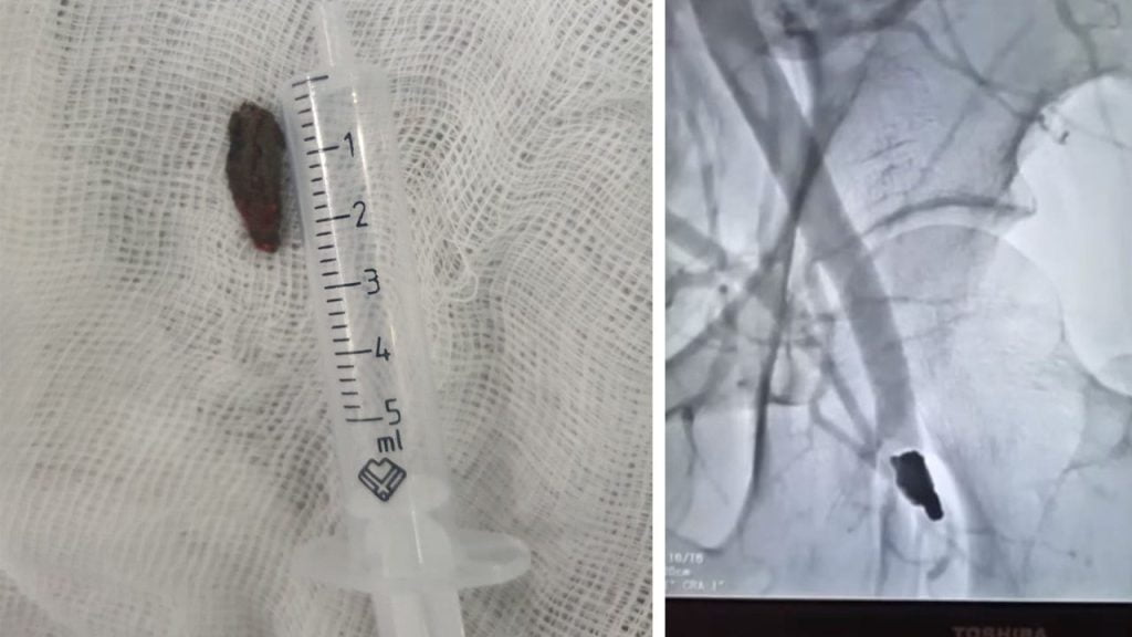 11-річному хлопчику замінили штучну судину в серці: в інституті Амосова блискуче провели операцію