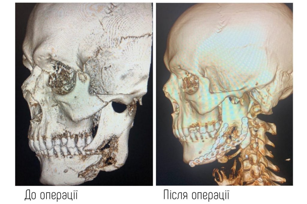 Відновити обличчя після поранення – це, як повернути себе: у Вінниці воїну зробили унікальну операцію Відновити обличчя після поранення – це, як повернути себе: у Вінниці воїну зробили унікальну операцію