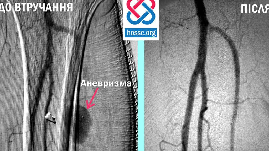 Поранення нижніх кінцівок обернулося аневризмою артерії – у Хмельницькому лікують бійця Поранення нижніх кінцівок обернулося аневризмою артерії – у Хмельницькому лікують бійця