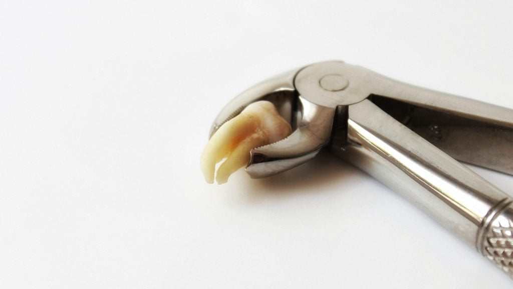 Карієс – давня хвороба: вчені виявили, що у 62% вікінгів були проблеми із зубами Карієс – давня хвороба: вчені виявили, що у 62% вікінгів були проблеми із зубами