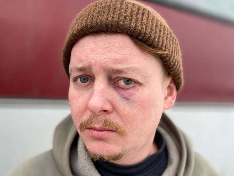 Актор із Чернігова Лемешко заявив, що його побив директор оперного театру у Дніпрі Пінчук. Артист звернувся в поліцію й показав гематому