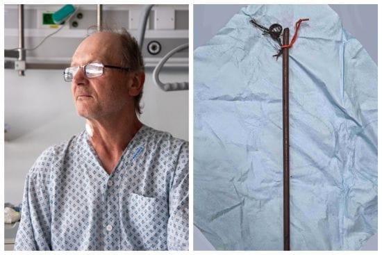 Чоловік дивом вижив після того, як впав на величезний залізний прут під час збирання вишні – фото