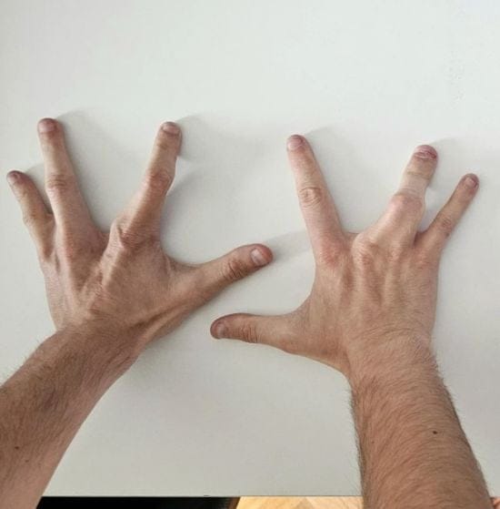 Чоловік народився із чотирма пальцями на кожній руці: що це за захворювання (фото)