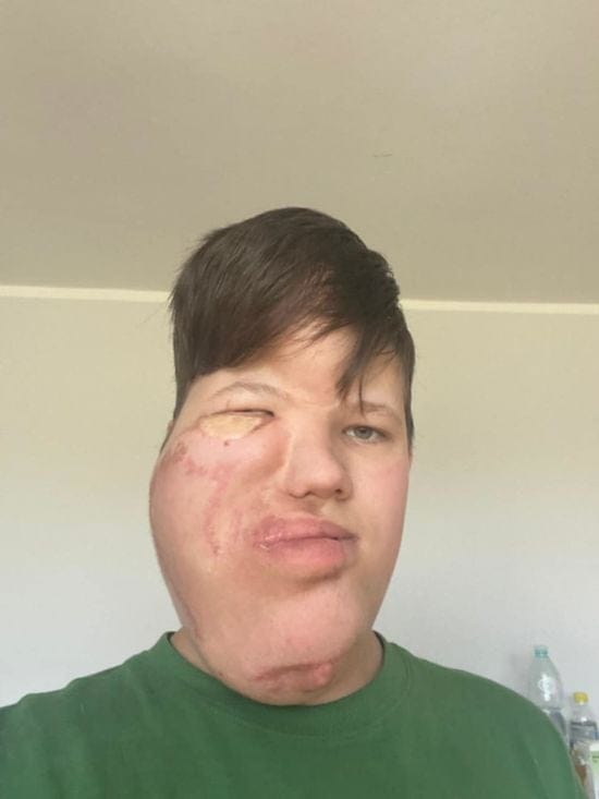 Син військового потребує дорогої операції, щоб виправити ваду обличчя