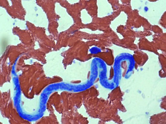 На Рівненщині з ока чоловіка лікарі витягнули 12-сантиметрового гельмінта