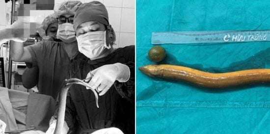 Засунув лимоном: із 31-річного чоловіка дістали живого вугра довжиною 65 см (фото)