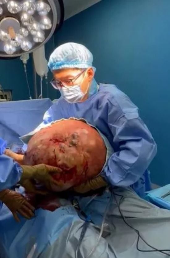 Лікарі видалили 30-кілограмову пухлину з живота жінки після місяців таємничого болю – фото