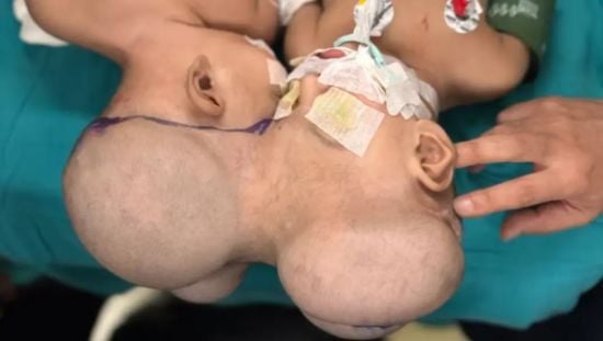Сіамських близнючок зі спільною мозковою тканиною розділили під час ризикованої операції – фото