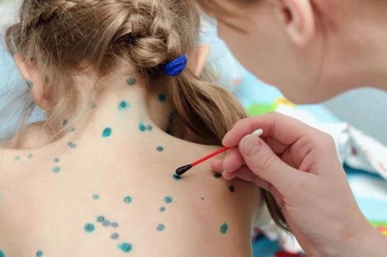 Вітряна віспа: які є міфи довкола хвороби та особливості лікування