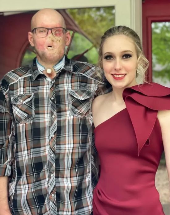 Перше в історії пересадження ока: фото чоловіка через рік після унікальної операції