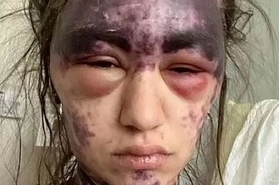 Осліпла і залишилася з синцями: жінка шокувала виглядом після "супердози" вакцини – фото