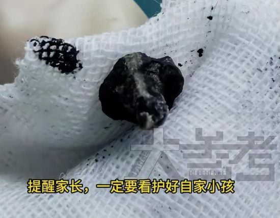 Медики спантеличені знахідкою у носі хлопчика, який два роки скаржився на неприємний запах – фото