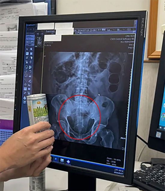 Лікарі шоковані: чоловік запхав собі в анус 12-сантиметрову бляшанку з-під газованки (фото)