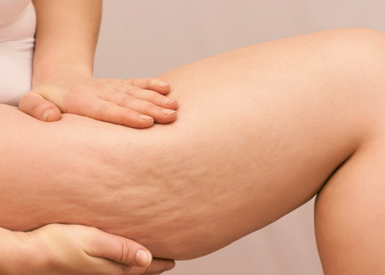 Простий секрет усіх жінок: чи правда, що за часів СРСР не було целюліту