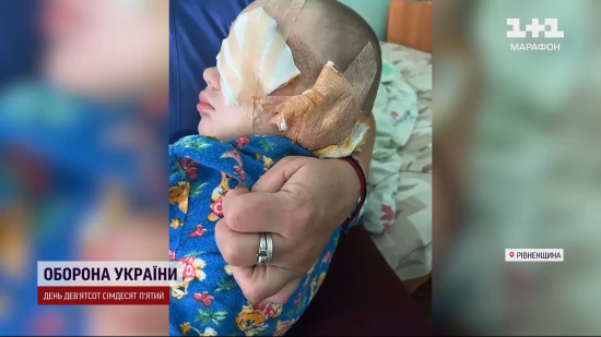 Виколоте око, травмоване вухо та синці: на Рівненщині жорстоко познущались з 2-річного хлопчика