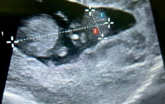 У жінки сталася вкрай рідкісна позаматкова вагітність у печінці – фото