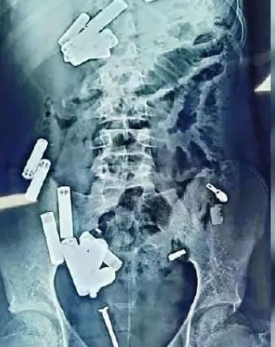 15-річний хлопчик помер після того, як хірурги дістали з його тіла 56 металевих предметів – фото