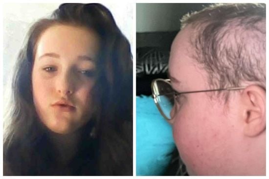 Жінка понад 10 років вириває волосся на голові: який вона має вигляд (фото)