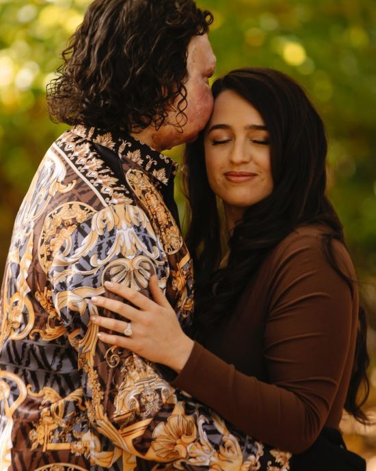 Перший чоловік, якому трансплантували обличчя, одружується: пара розсекретила, яким буде весілля