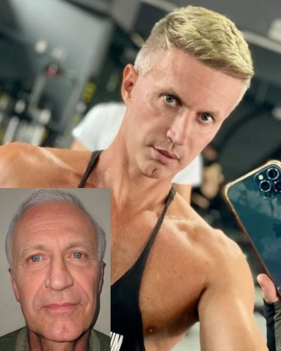Чоловік "помолодшав на 40 років" після пластики обличчя – фото