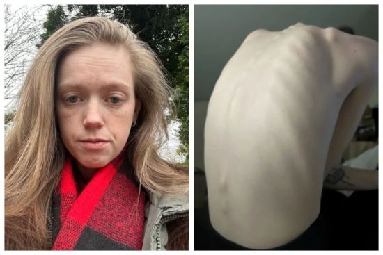 Жінка мусить стояти, коли їсть і п'є: що відомо про надзвичайно рідкісний стан (фото)