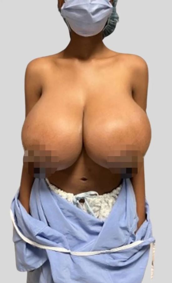 Перший випадок: груди 19-річної жінки втричі збільшилися після вакцинації від COVID – фото