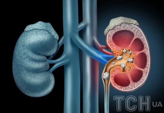 Камені в нирках: продукти, які провокують їх появу