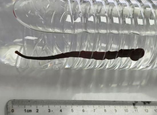 У легенях семирічного хлопчика виросла 12-сантиметрова п'явка – фото