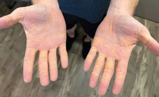 Чоловік нажахав наслідками популярної дієти – фото