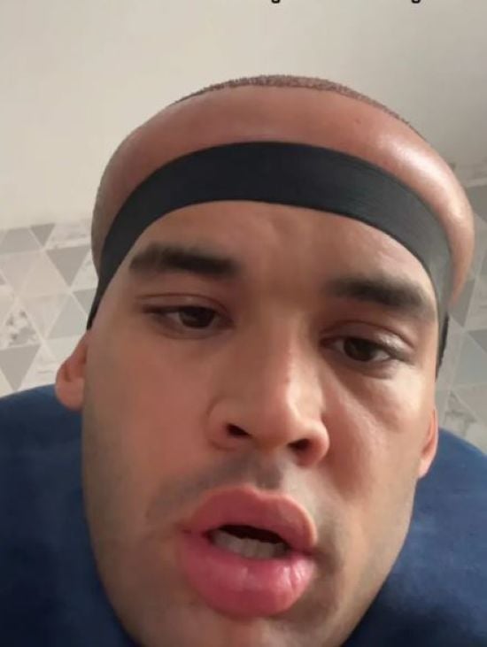 Чоловік нажахав побічним ефектом трансплантації волосся – фото