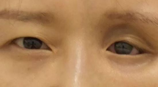 П'ять лінз за одним оком: лікарі випадково зробили шокувальне відкриття – фото