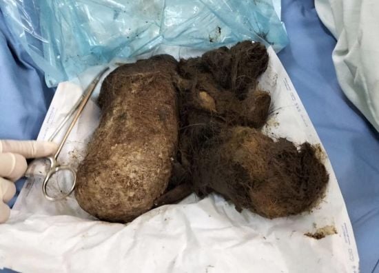 Зі шлунка дівчини видалили 1 кг волосся (фото)