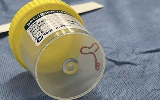 Відвідав баню – отримав гельмінта: у чоловіка на Рівненщині знайшли 8-сантиметрового паразита Відвідав баню – отримав гельмінта: у чоловіка на Рівненщині знайшли 8-сантиметрового паразита