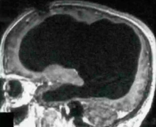 Чоловік випадково виявив, що живе з половиною мозку – фото