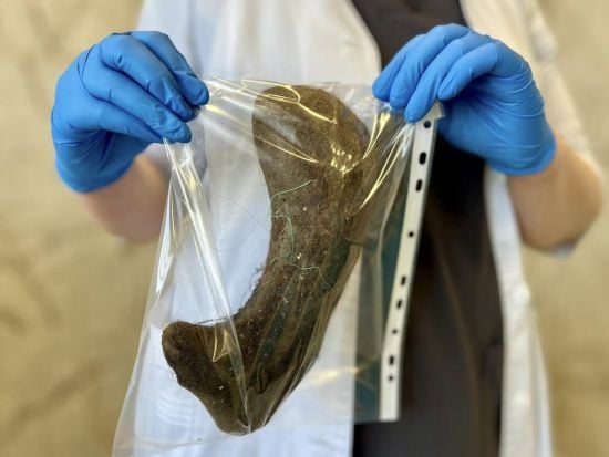 Вражаюча операція у Києві: лікарі витягли з шлунка дитини величезний камінь із волосся