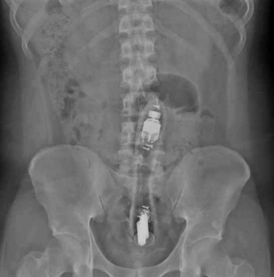 Нажаханий чоловік жалівся на біль у сідницях: його знудило після знахідки всередині (фото)