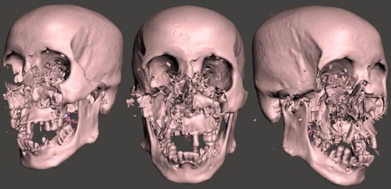 Хірурги врятували чоловіка, якому ведмідь роздер обличчя: який він зараз має вигляд (фото)