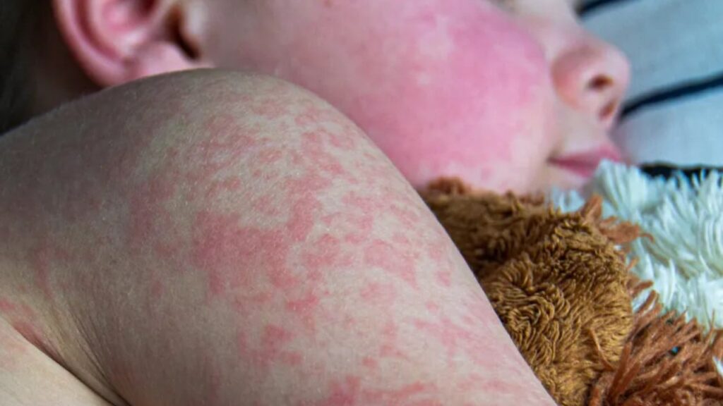 Спалах кору в США: понад 500 підтверджених випадків у п’яти штатах