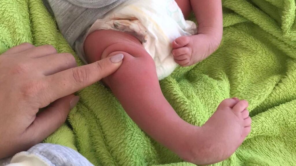 Клишоногість не вирок: ортопеди Рівного врятували немовля