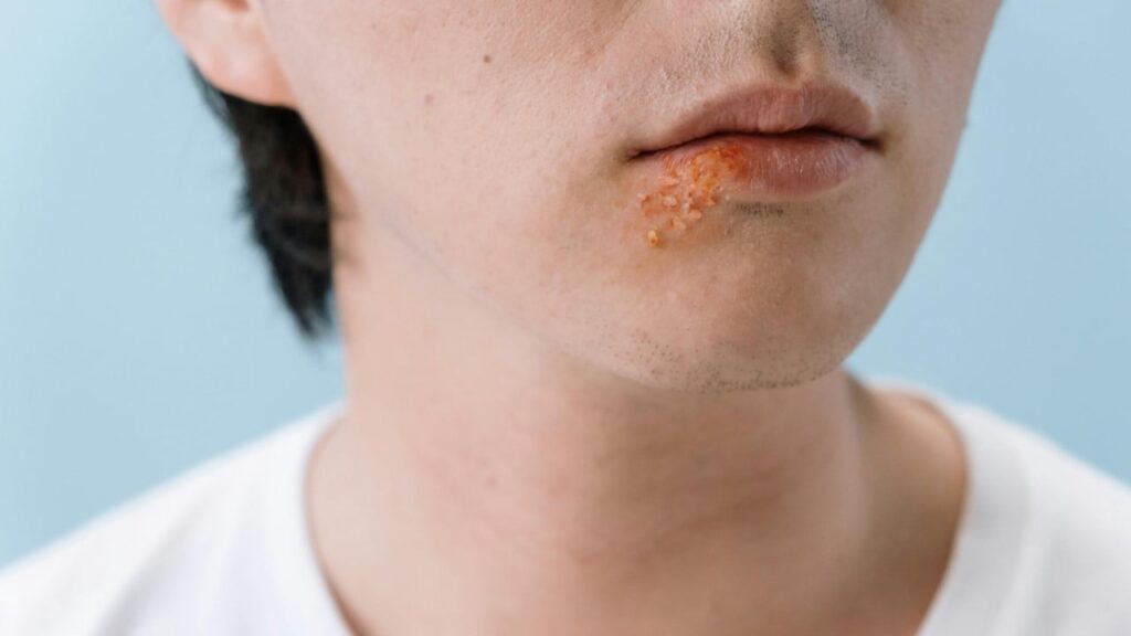 Дослідники виявили зв’язок між герпесом та хворобою Альцгеймера