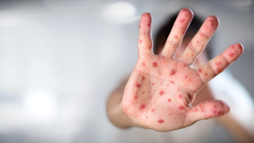 Найзаразніша хвороба: учений пояснив, чому світові потрібно готуватися до спалаху кору