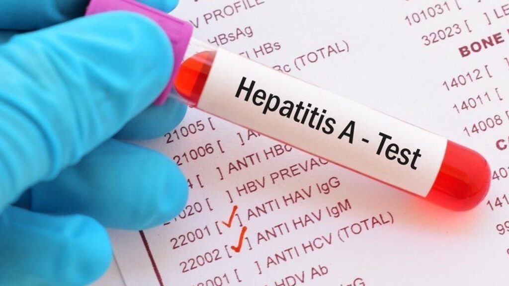 Санлікар Києва про спалах гепатиту А: Нові випадки пов’язані з побутовими контактами