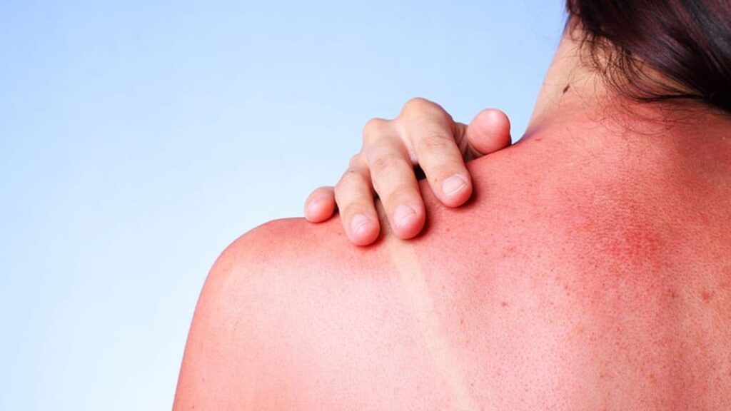 Як швидко вилікувати сонячний опік: поради дерматолога