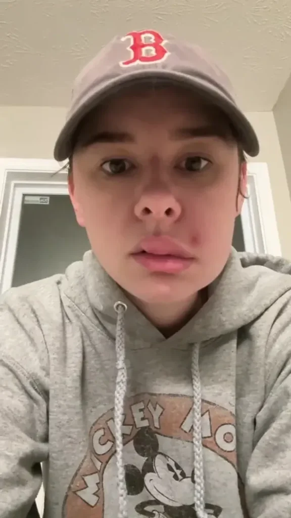 Видавлений прищ ледь не коштував здоров’я: що сталося з обличчям дівчини