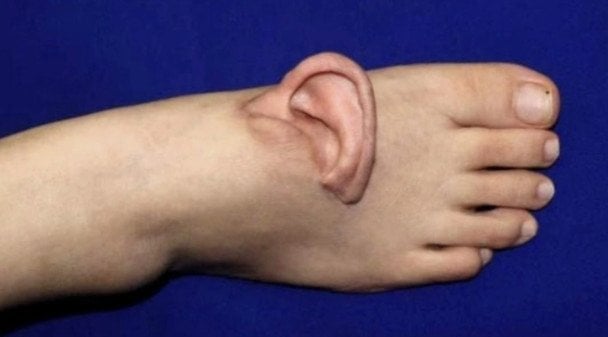 Хірурги пришили жінці вухо до стопи: що сталося (фото)