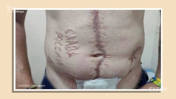 Назвали російських хірургів, які могли випалити на тілі українського бранця напис «Слава России»